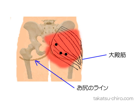 大殿筋のトリガーポイント関連痛領域