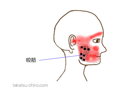 咬筋のトリガーポイント関連痛領域