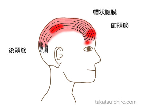 後頭筋・前頭筋のトリガーポイントの関連痛領域