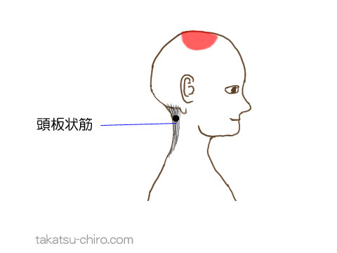 頭板状筋のトリガーポイント関連痛領域
