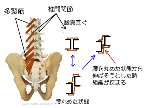 ぎっくり腰、組織の挟み込み