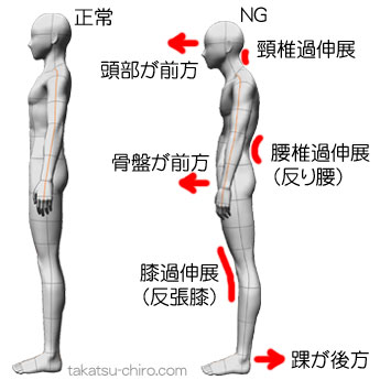 スーパーフィシャル・バック・ライン(SBL)に問題がある場合の不良姿勢