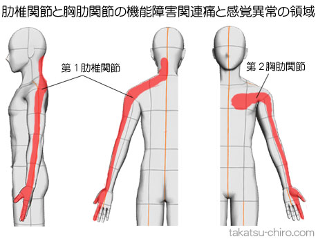 肋椎関節と胸肋関節の機能障害の関連痛と感覚異常の領域
