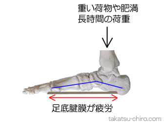 過負荷による足裏の痛み足底腱膜炎