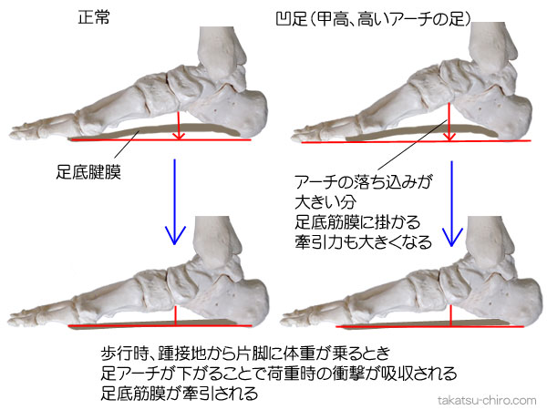 凹足、甲高の足の足裏の指の付け根の痛み、足底腱膜炎