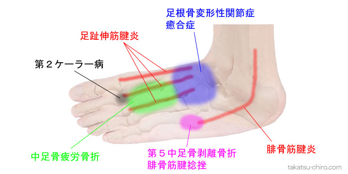 足の甲、足の外側の痛み