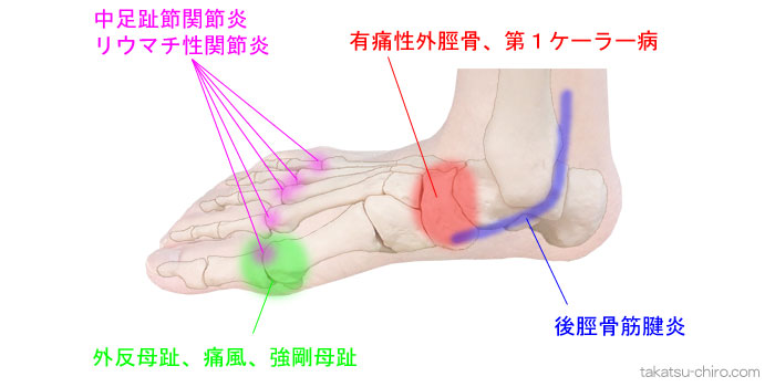 足の内側の痛み
