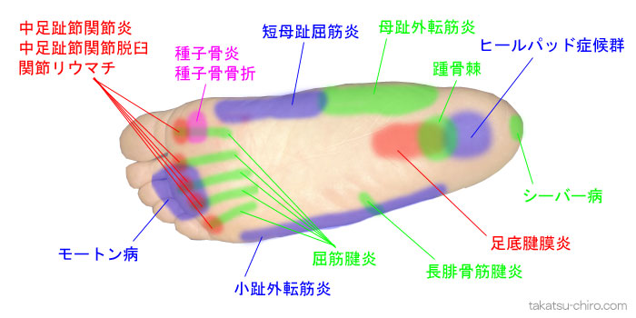 足裏の痛み、踵の痛み
