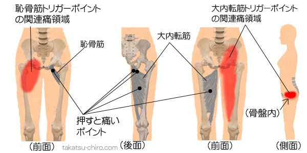 恥骨筋と大内転筋のトリガーポイント関連痛