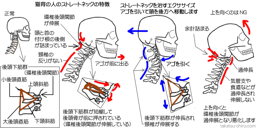 猫背のストレートネックの特徴とストレートネックを自分で治すエクササイズ