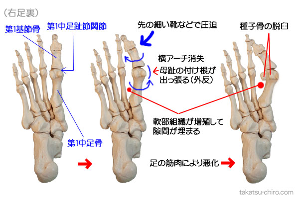 外反母趾、外反母趾の骨の捻れ方