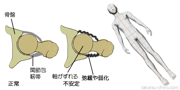 股関節不安定性の例