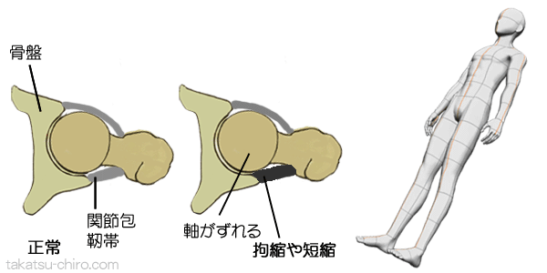 股関節機能障害の例