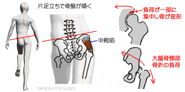 中殿筋の弱化によるトレンデンブルク、変形性股関節症、大腿骨頸部骨折