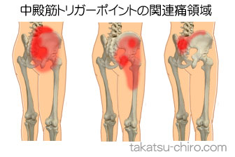 中殿筋の下肢の痛みの領域
