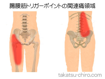 腸腰筋の下肢の痛みの領域