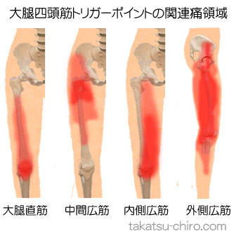 大腿四頭筋の下肢の痛みの領域