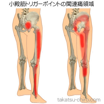 小殿筋の下肢の痛みの領域