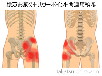 腰方形筋の下肢の痛みの領域