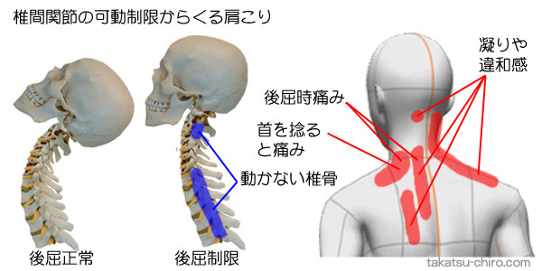 椎間関節の可動制限からくる肩こり