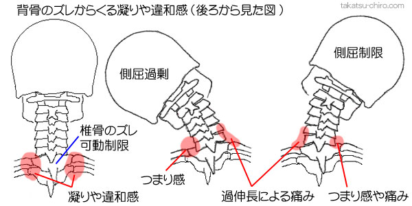 背骨のズレからくる肩こり、つまり感、違和感、痛み、違和感