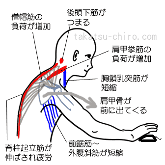 デスクワークの肩こり