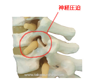 神経圧迫