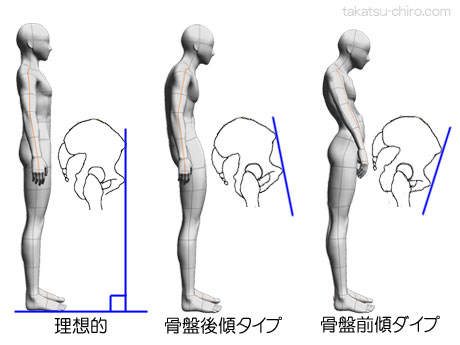猫背を自分で治す方法、骨盤後傾タイプの猫背と骨盤前傾タイプの猫背