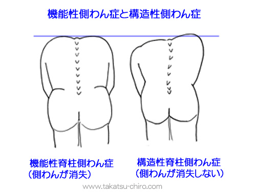 機能性側弯症と構造性側弯症の判別方法