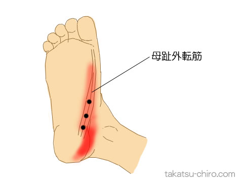 母趾外転筋のトリガーポイント関連痛領域