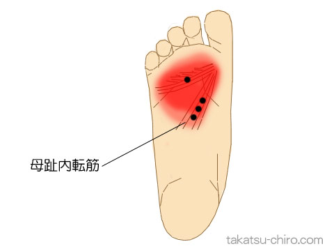 母趾内転筋のトリガーポイント関連痛領域