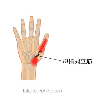 母指対立筋のトリガーポイント関連痛領域