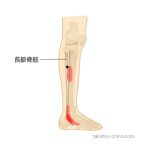 長腓骨筋のトリガーポイント関連痛領域