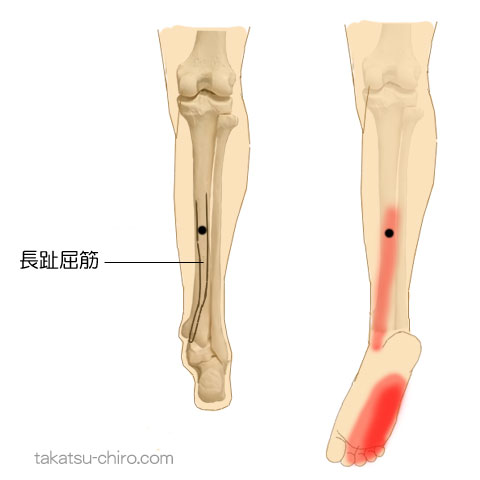 長趾屈筋のトリガーポイント関連痛領域