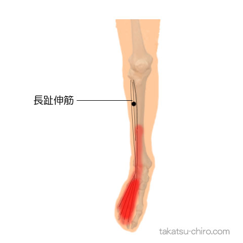 長趾伸筋のトリガーポイント関連痛領域