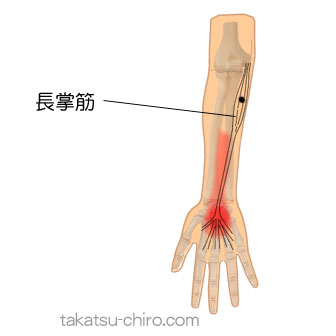 長掌筋のトリガーポイント関連痛領域