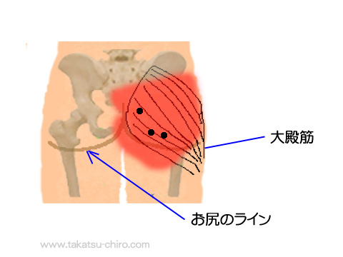 大殿筋のトリガーポイント関連痛領域
