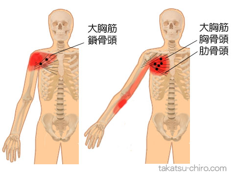 大胸筋のトリガーポイント関連痛領域