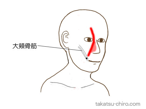 大頬骨筋のトリガーポイント関連痛領域
