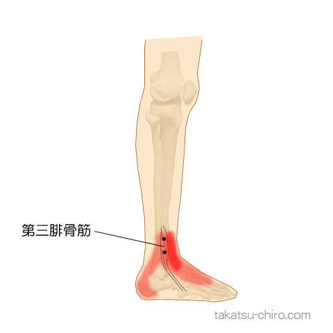 第三腓骨筋のトリガーポイント関連痛領域