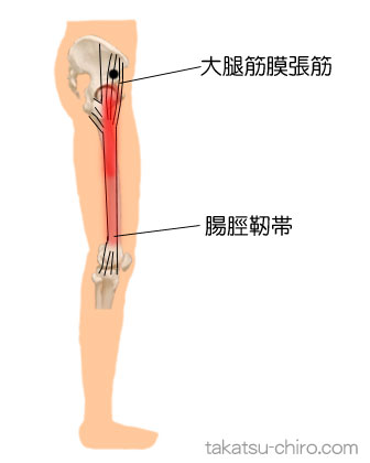 大腿筋膜張筋のトリガーポイント関連痛領域