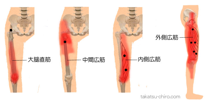 大腿四頭筋のトリガーポイント関連痛領域