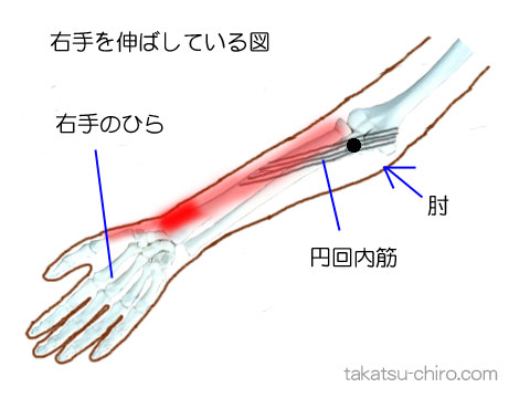 円回内筋のトリガーポイント関連痛領域