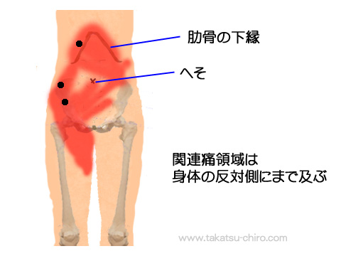 内腹斜筋および外腹斜筋のトリガーポイント関連痛領域