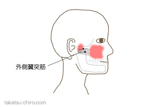 外側翼突筋のトリガーポイント関連痛領域