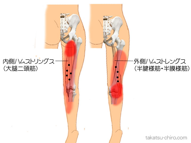 ハムストリングスのトリガーポイント関連痛領域