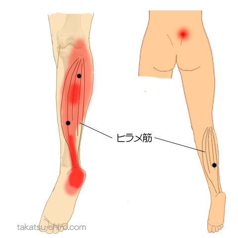 ヒラメ筋のトリガーポイント関連痛領域