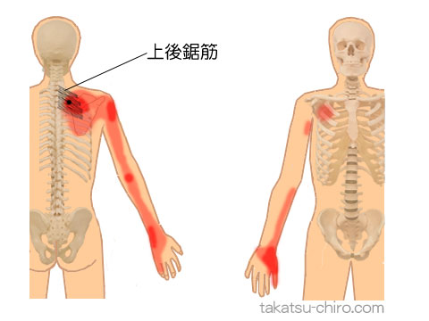 上後鋸筋のトリガーポイント関連痛領域