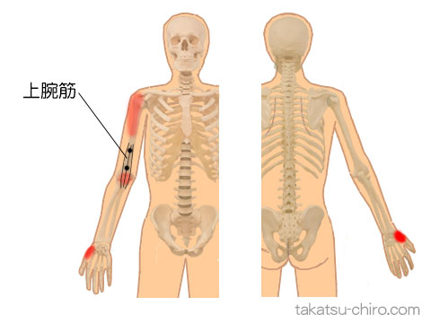 上腕筋のトリガーポイント関連痛領域