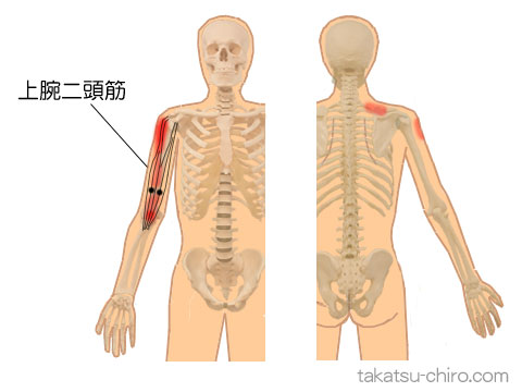 上腕二頭筋のトリガーポイント関連痛領域